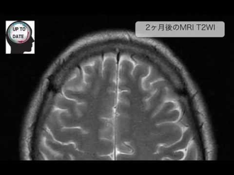 脳挫傷のCT画像を診断するwidth=190